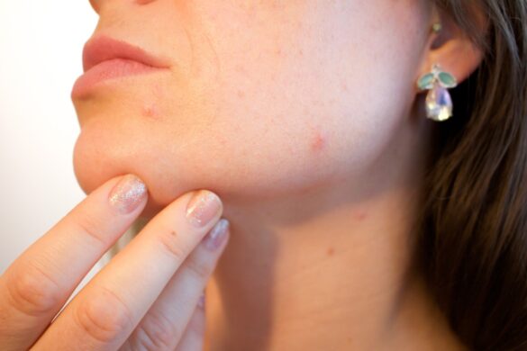 Skin Cancer Doesn’t Discriminate