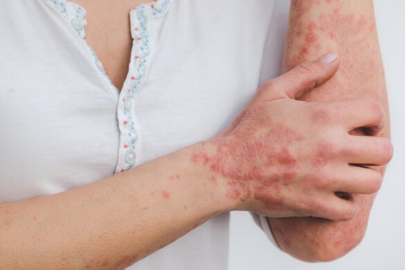 Study Shows Link Between Vitamin D And Psoriasis Severity