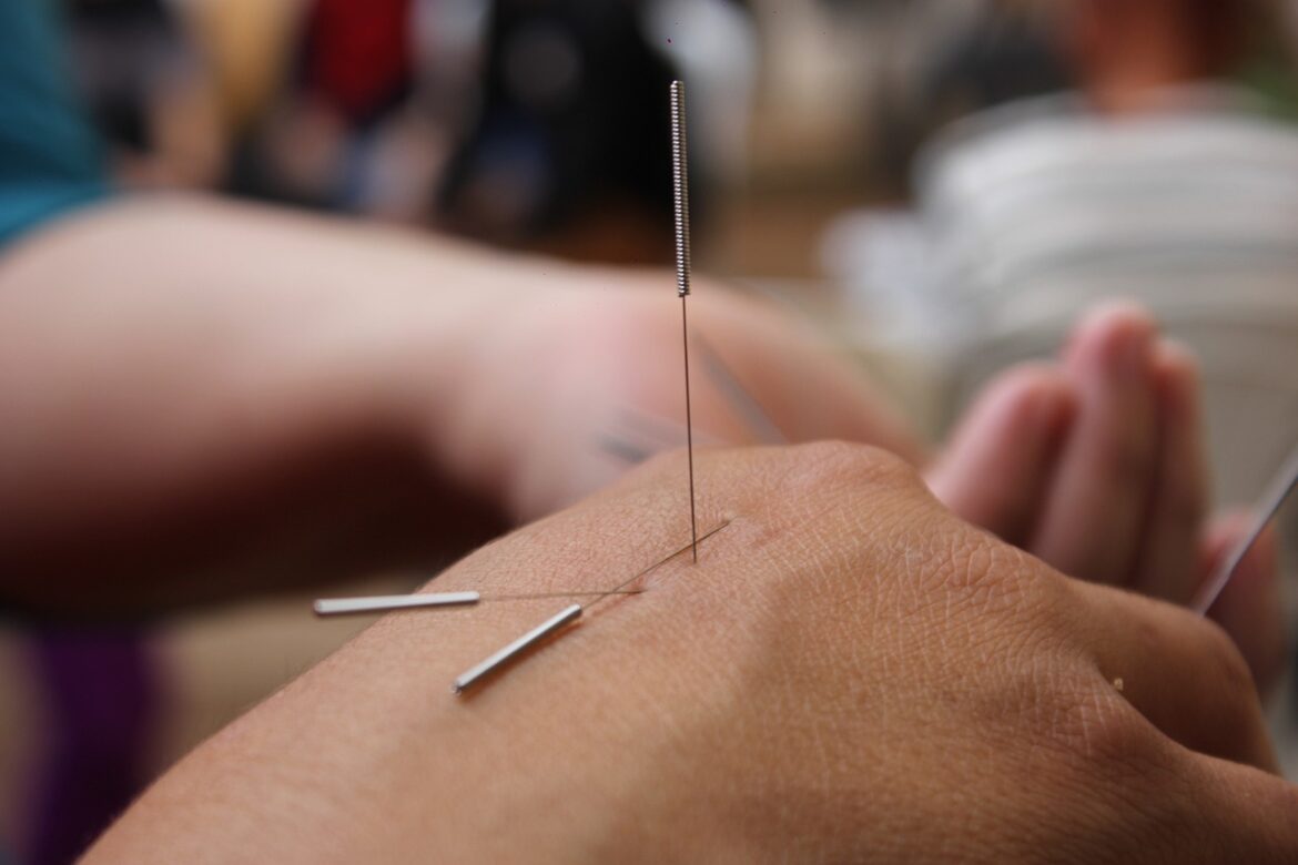It is estimated that there are around 10 million acupuncture treatments administered each year across the U.S